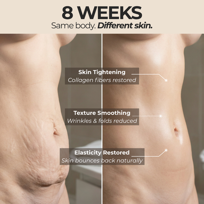 SYNELUX™ | The #1 Red Light Belt for Post-Weight-Loss Skin